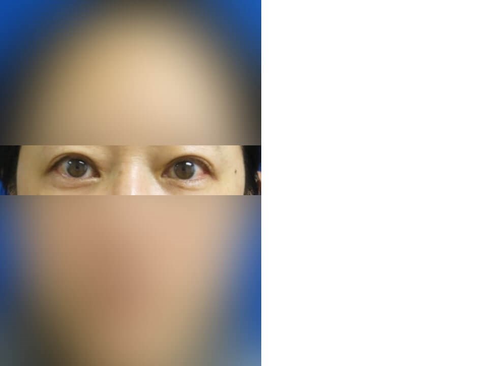 Upper Eyelid Surgery After