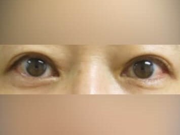 Upper Eyelid Surgery After