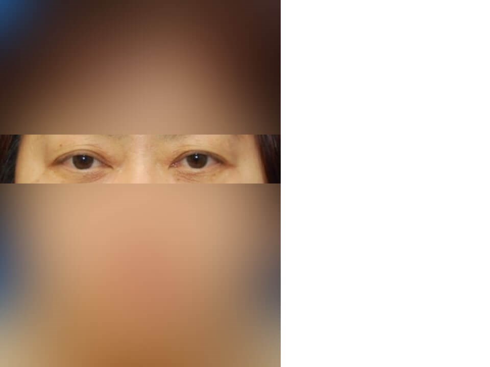 Upper Eyelid Surgery Before