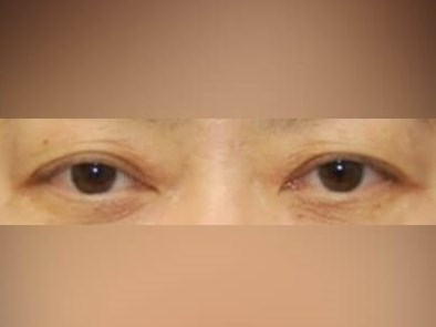 Upper Eyelid Surgery Before