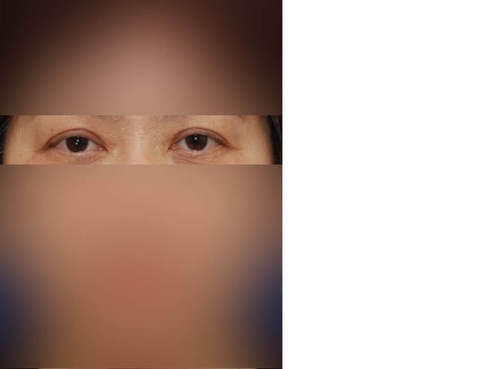 Upper Eyelid Surgery After