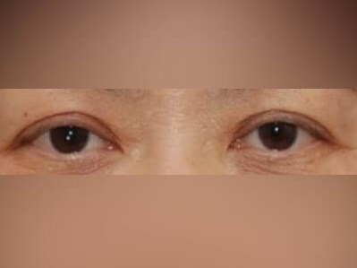 Upper Eyelid Surgery After