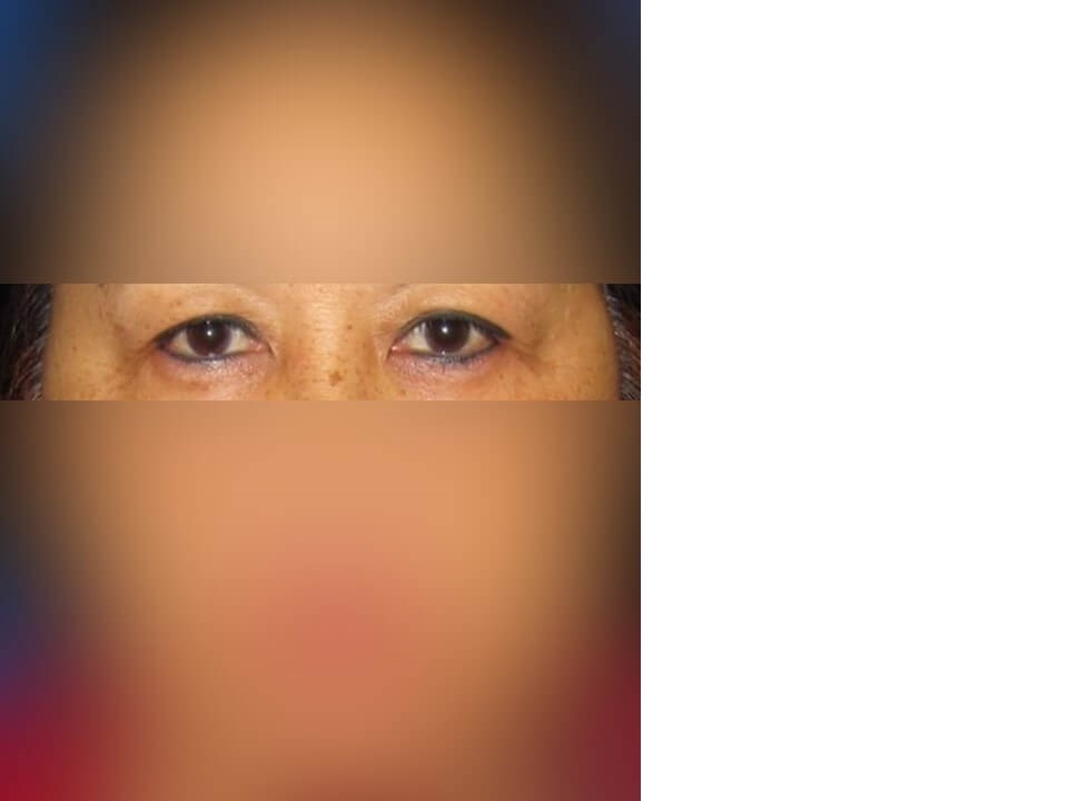 Upper Eyelid Surgery Before