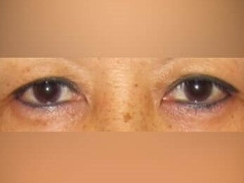 Upper Eyelid Surgery Before