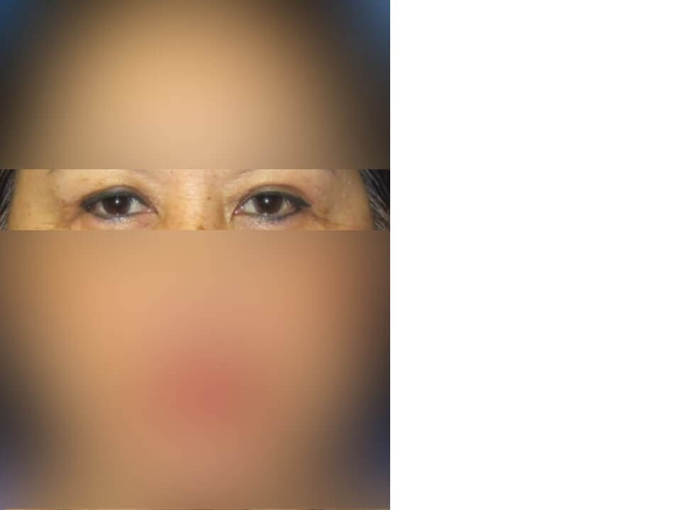 Upper Eyelid Surgery After