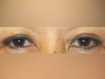 Upper Eyelid Surgery After