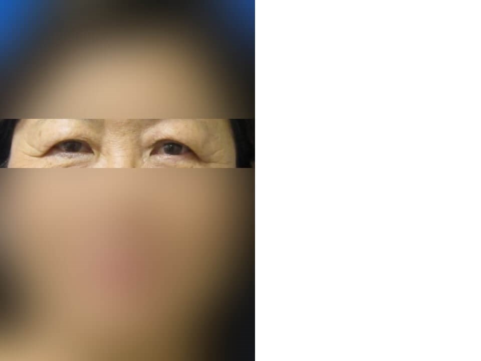 Upper Eyelid Surgery Before