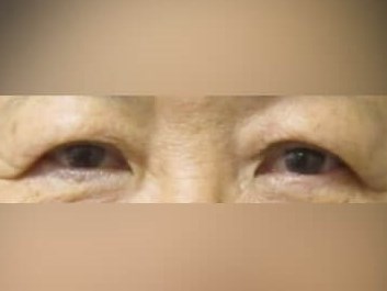 Upper Eyelid Surgery Before