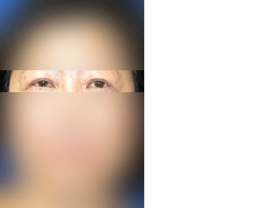 Upper Eyelid Surgery After