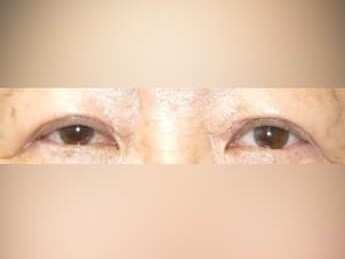 Upper Eyelid Surgery After