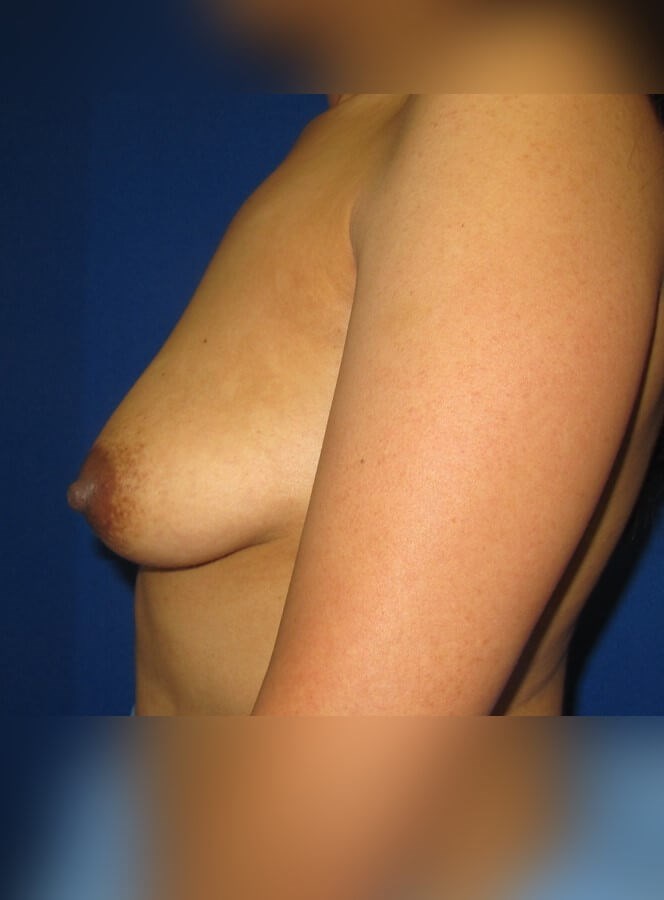 Breast Augmentation Before