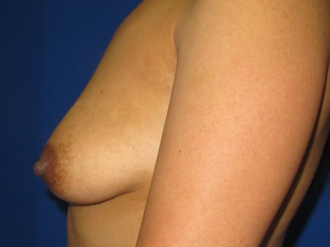 Breast Augmentation Before