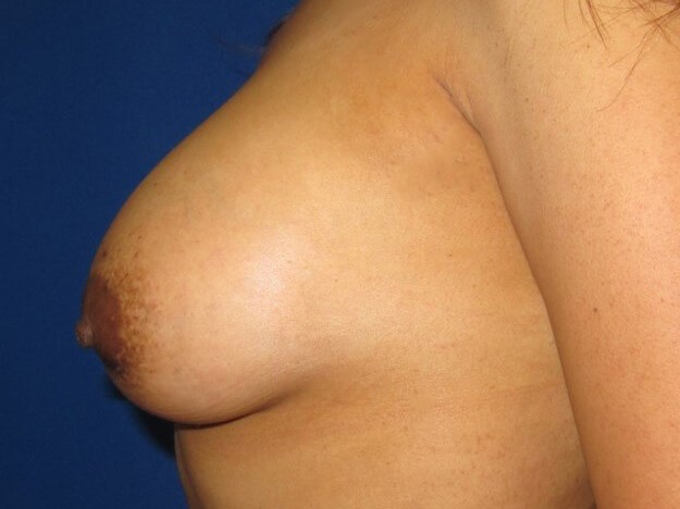 Breast Augmentation After