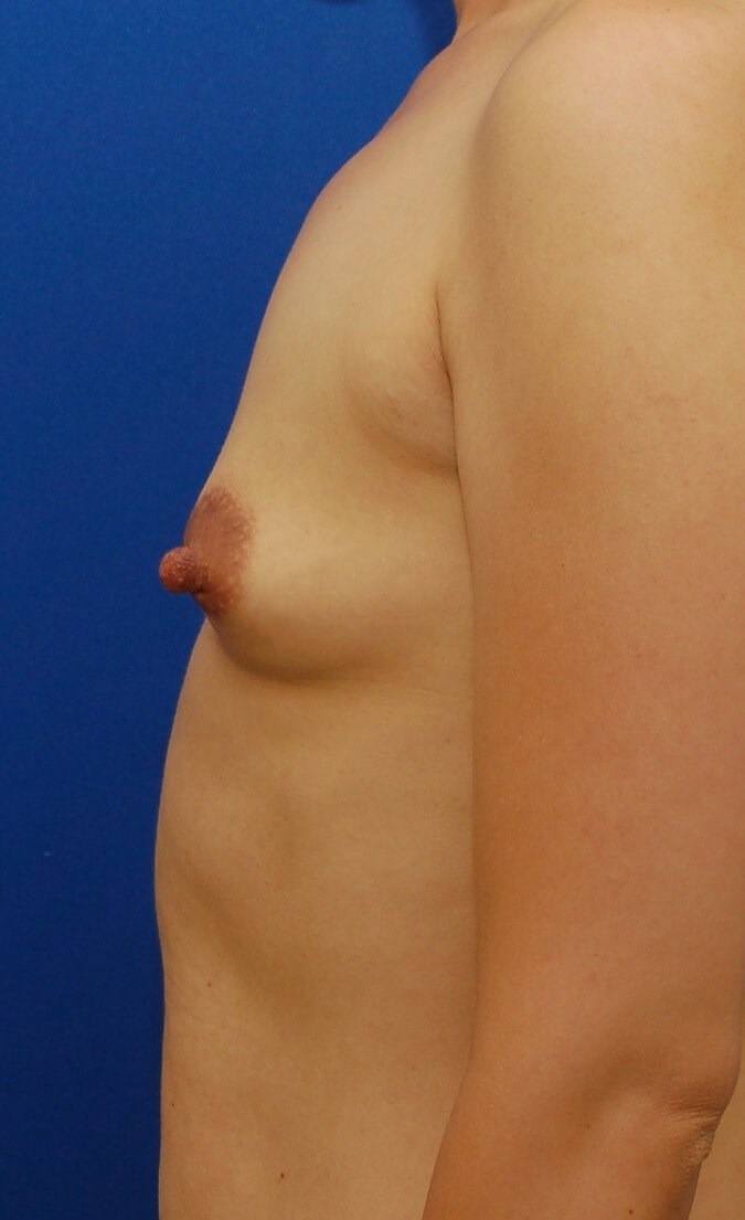 Breast Augmentation Before