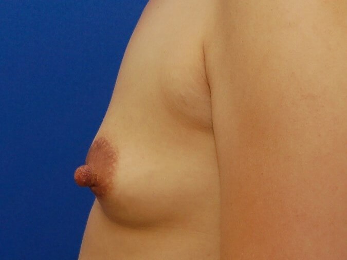 Breast Augmentation Before
