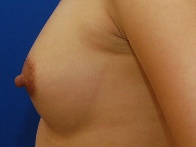Breast Augmentation After
