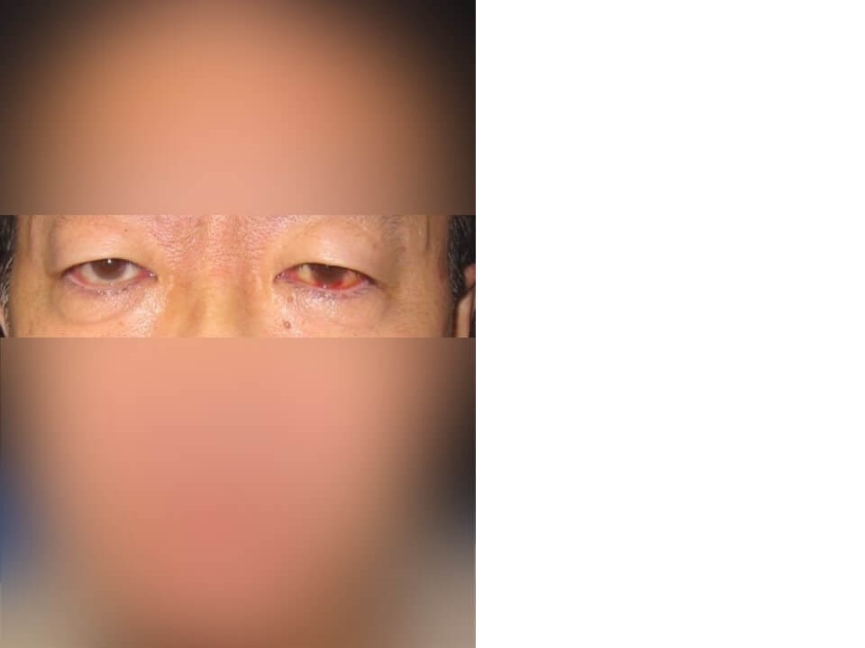 Upper Eyelid Surgery Before