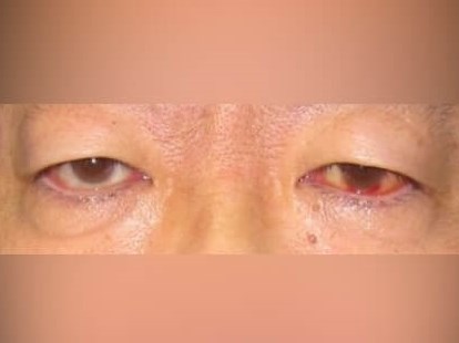 Upper Eyelid Surgery Before