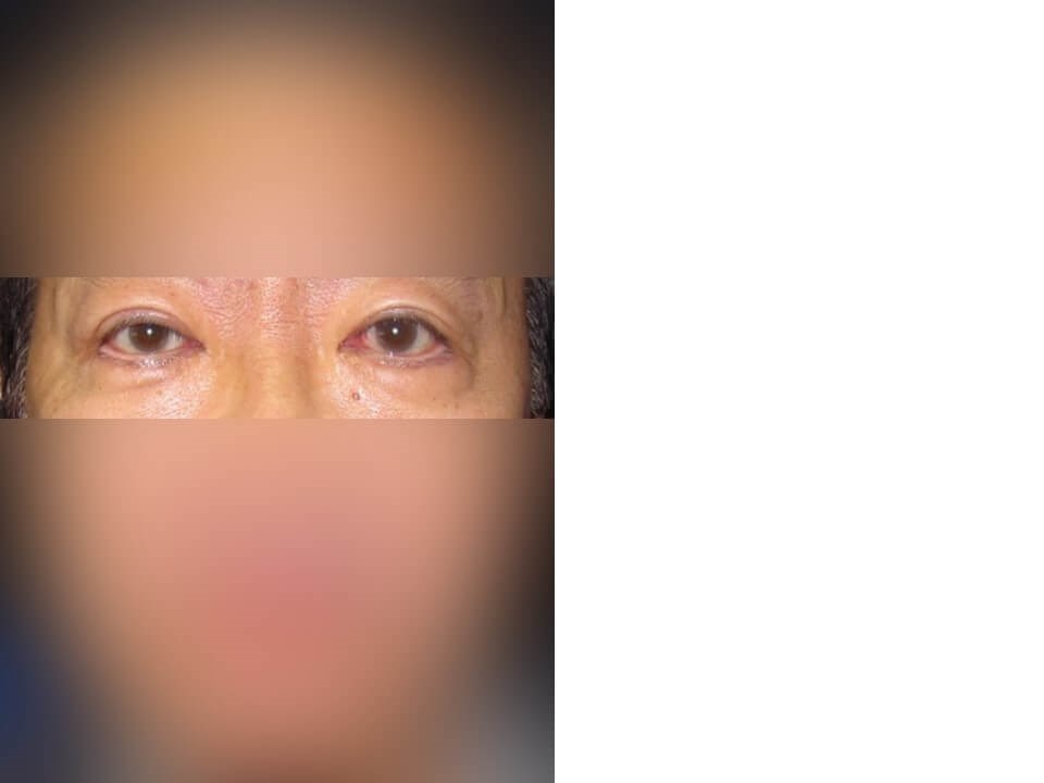 Upper Eyelid Surgery After