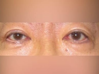 Upper Eyelid Surgery After