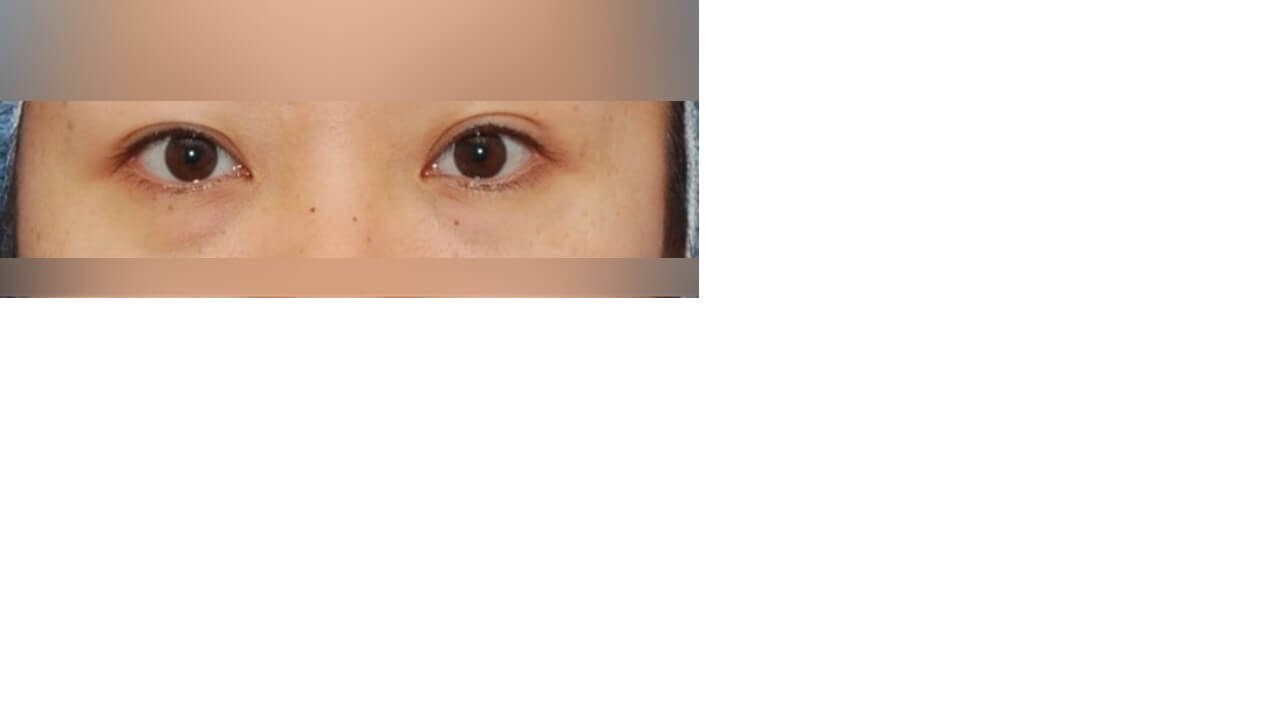 Lower Eyelid Surgery Before