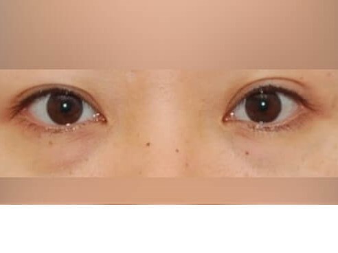 Lower Eyelid Surgery Before