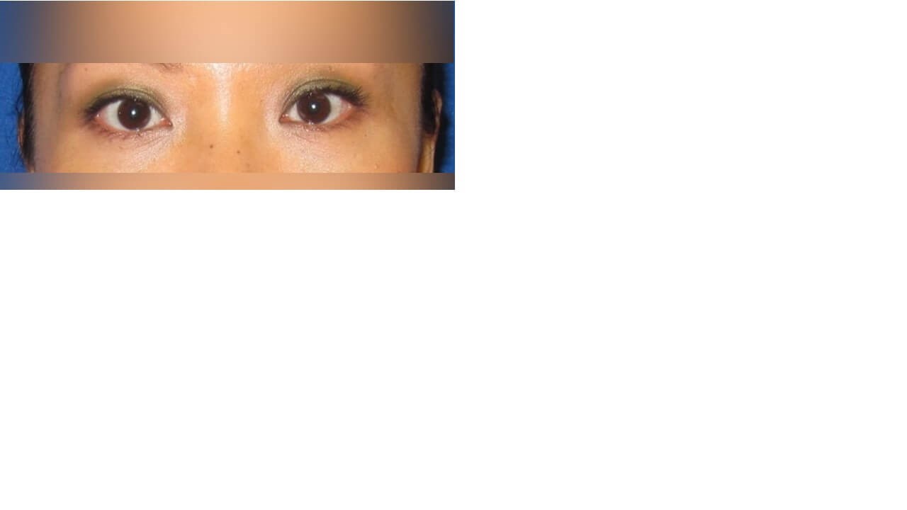 Lower Eyelid Surgery After