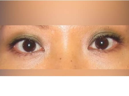 Lower Eyelid Surgery After