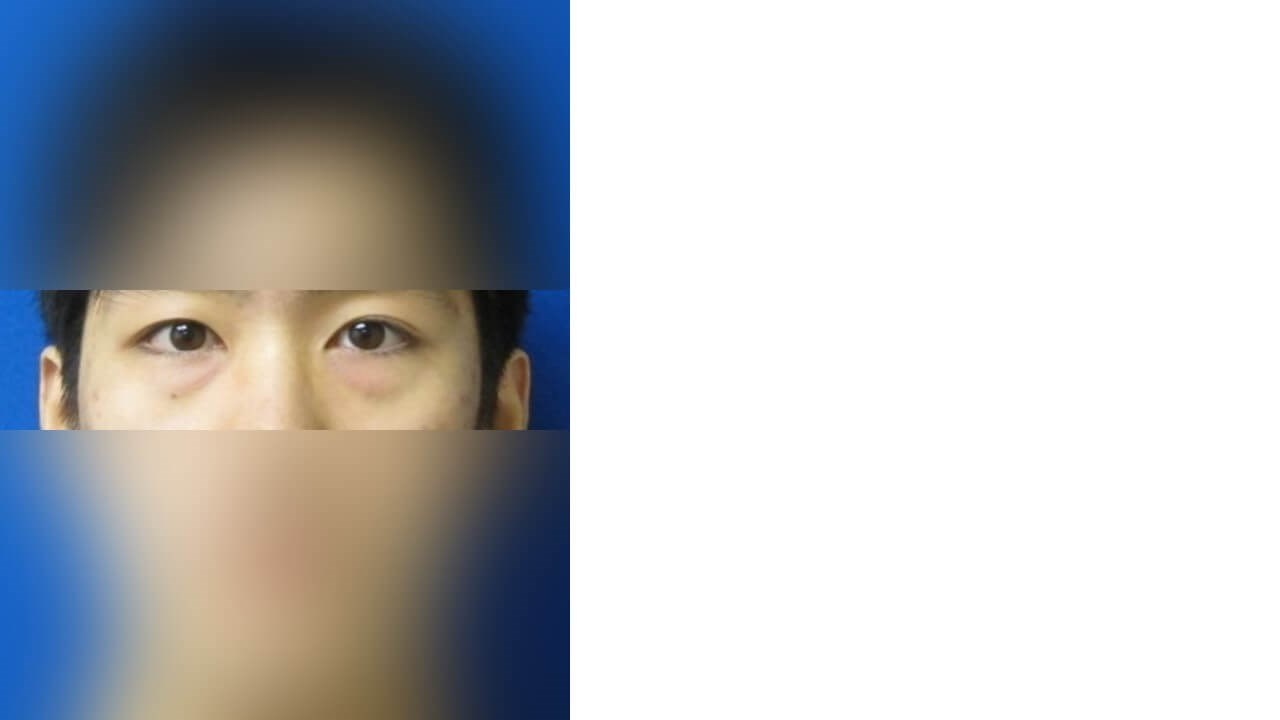 Lower Eyelid Surgery Before