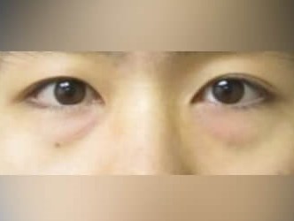 Lower Eyelid Surgery Before