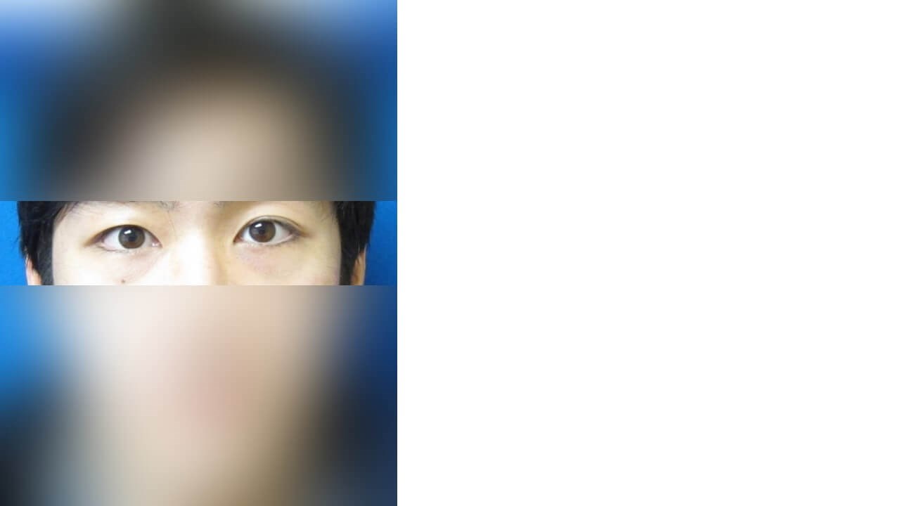 Lower Eyelid Surgery After