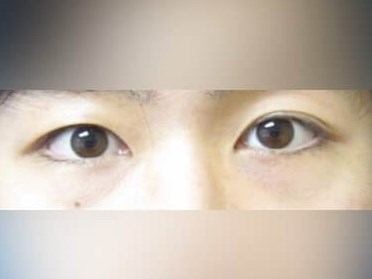 Lower Eyelid Surgery After
