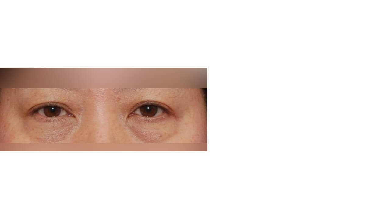Lower Eyelid Surgery Before