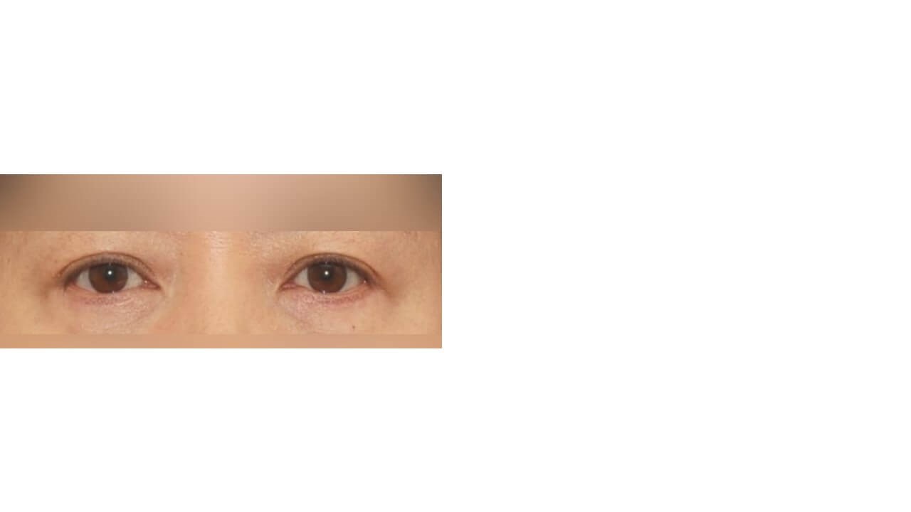 Lower Eyelid Surgery After