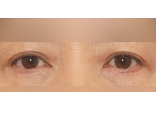 Lower Eyelid Surgery After