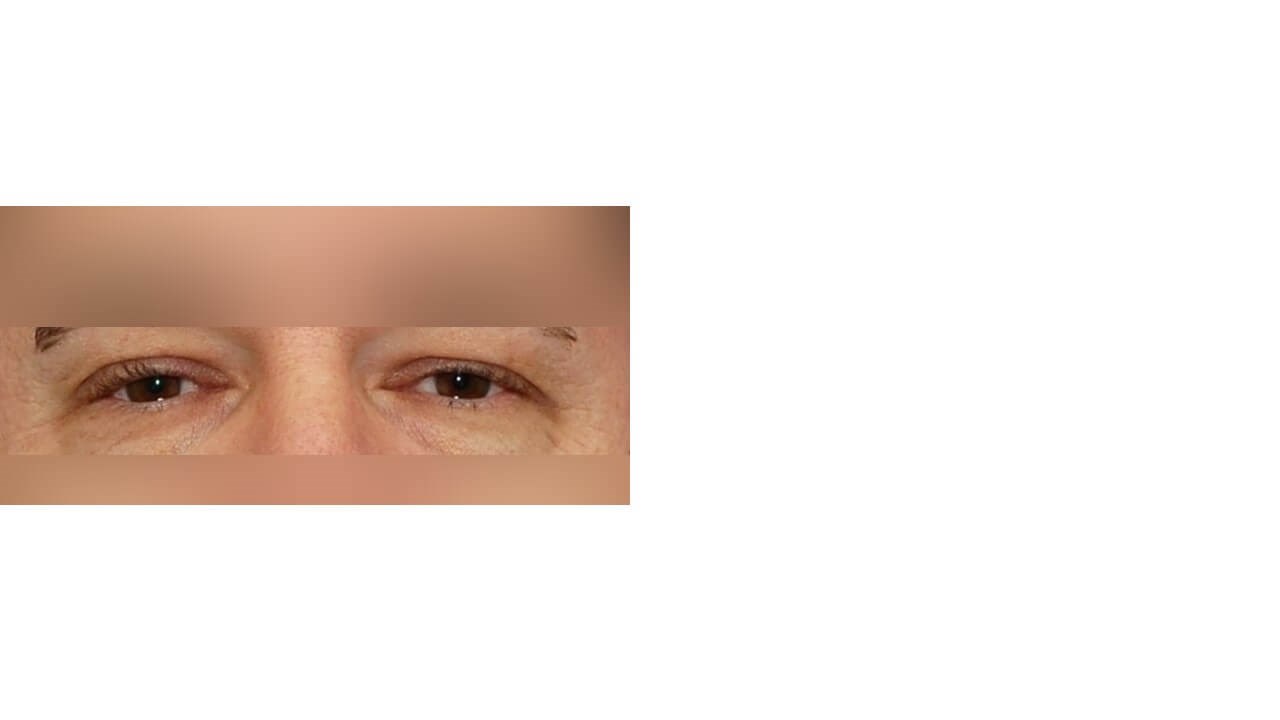 Lower Eyelid Surgery Before