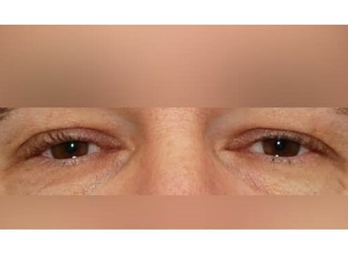 Lower Eyelid Surgery Before