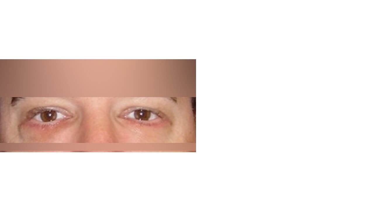 Lower Eyelid Surgery After