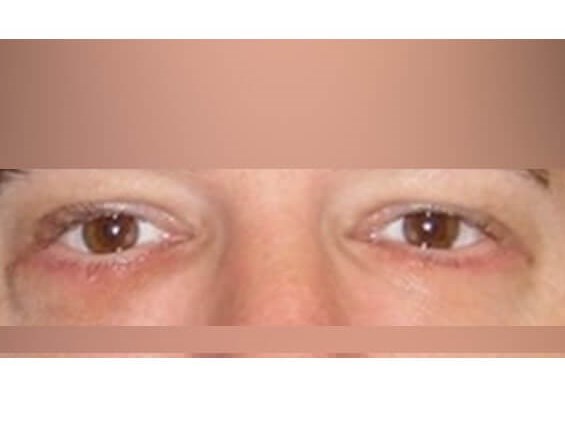 Lower Eyelid Surgery After