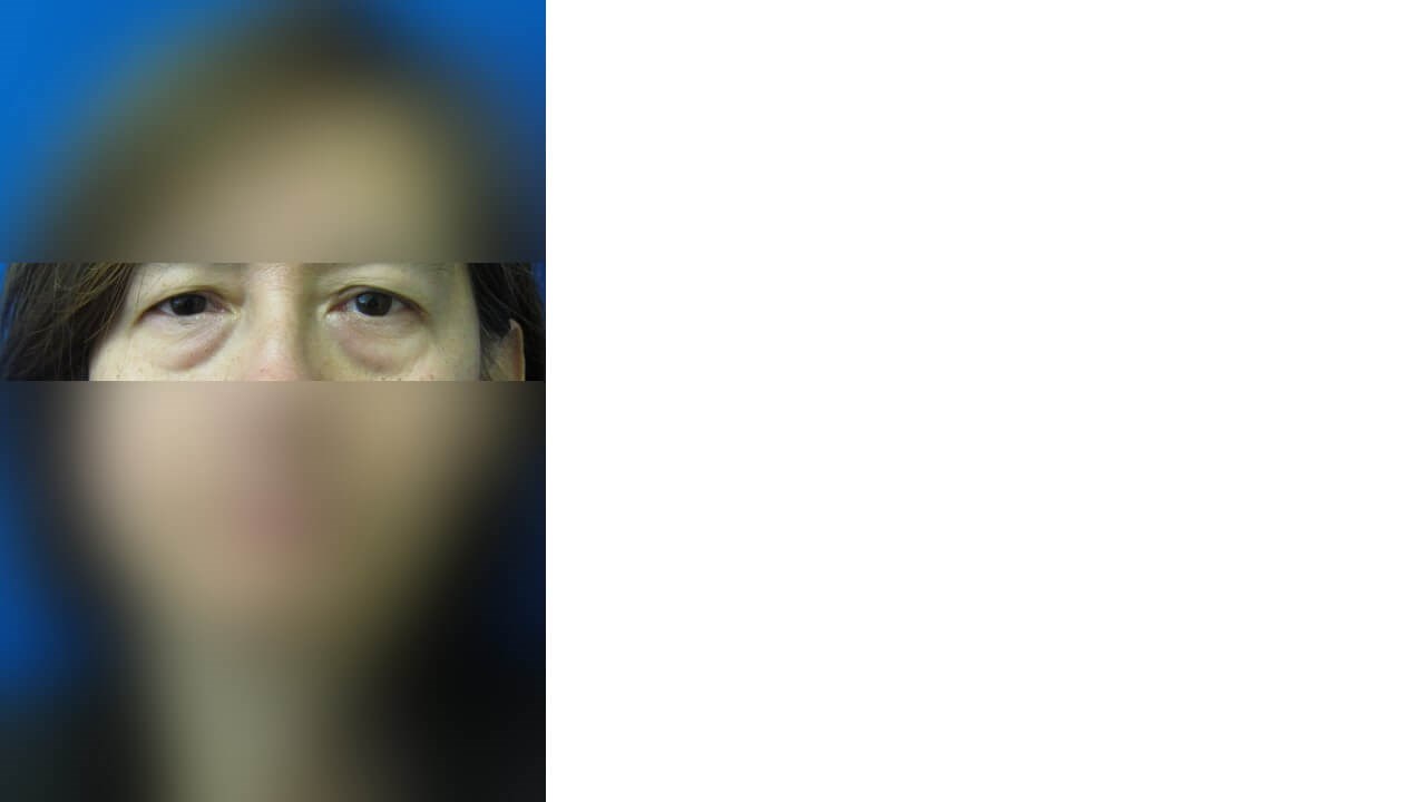 Lower Eyelid Surgery Before