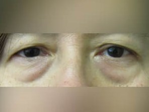 Lower Eyelid Surgery Before