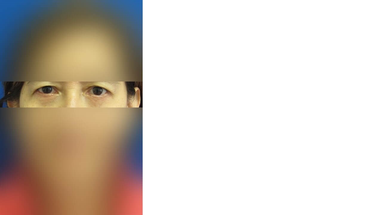 Lower Eyelid Surgery After