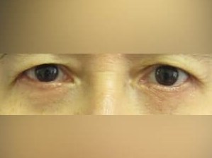 Lower Eyelid Surgery After