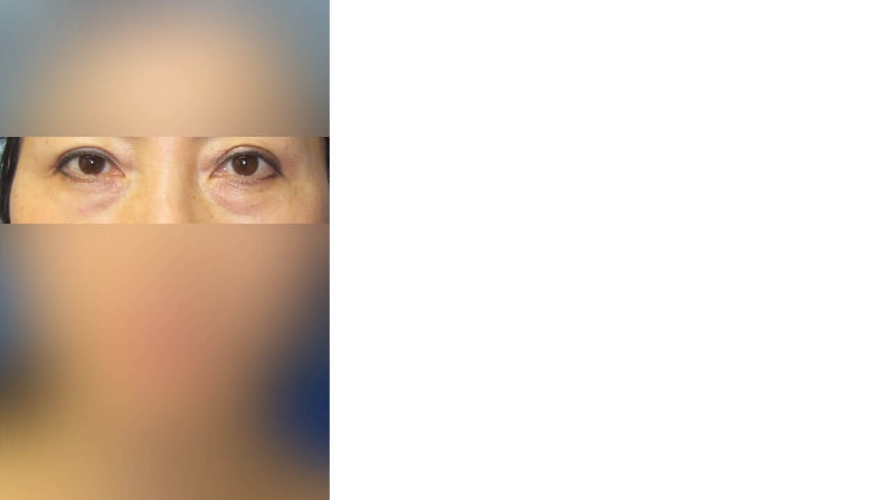 Lower Eyelid Surgery Before