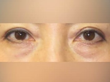 Lower Eyelid Surgery Before