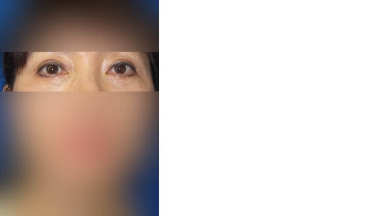 Lower Eyelid Surgery After