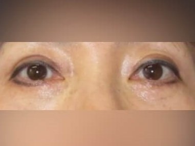 Lower Eyelid Surgery After