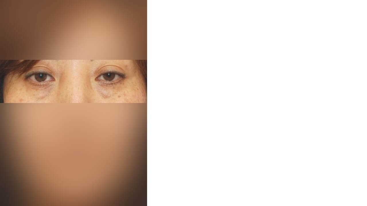 Lower Eyelid Surgery Before