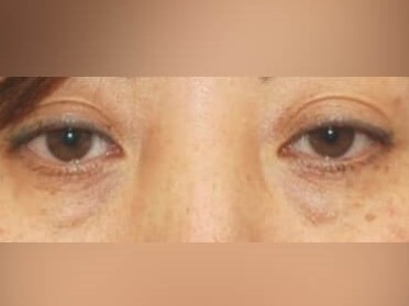 Lower Eyelid Surgery Before