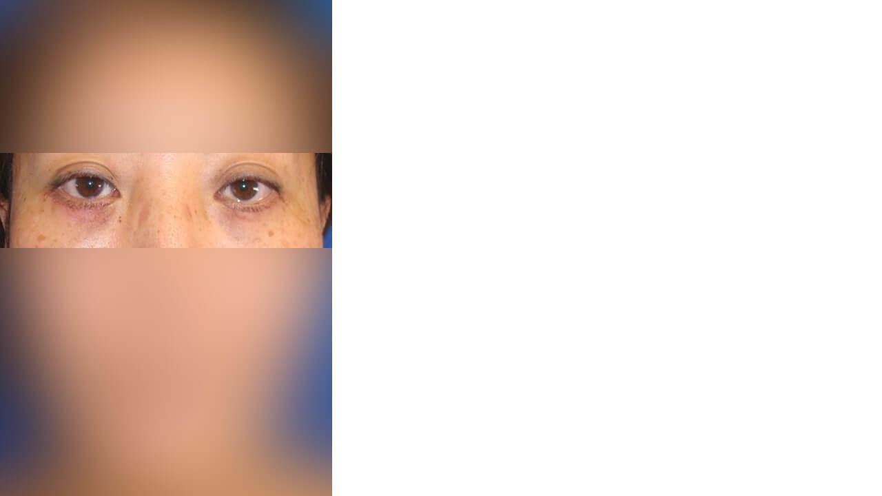Lower Eyelid Surgery After